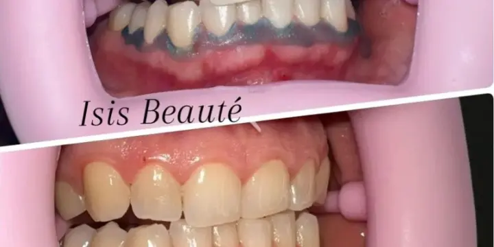 Blanchiment dentaire americain