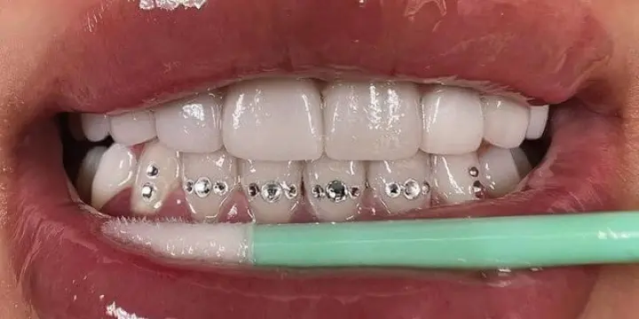 Blanchiment dentaire américain, Nanoneedling