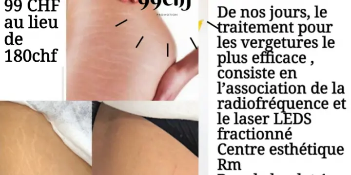 Traitement des vergetures