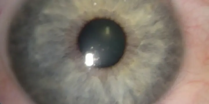 Bilan iridologique Médecine naturelle