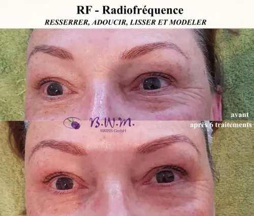 Lifting du visage avec RF - Tripolar à Sierre