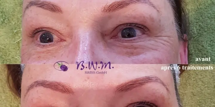 Lifting du visage avec RF - Tripolar