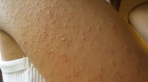 Psoriasis, eczéma, dyshidrose et dermatoses