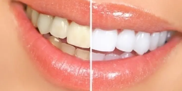  Nouveau Blanchiment des Dents