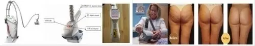Body shape and Cellulite removal machine à Beijing