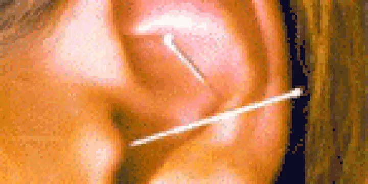 Auriculotherapie-Thérapeute ASCA