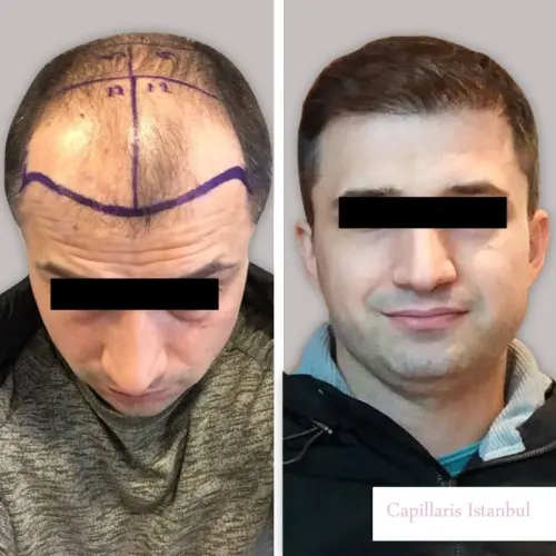 Greffe de cheveux Turquie à geneve