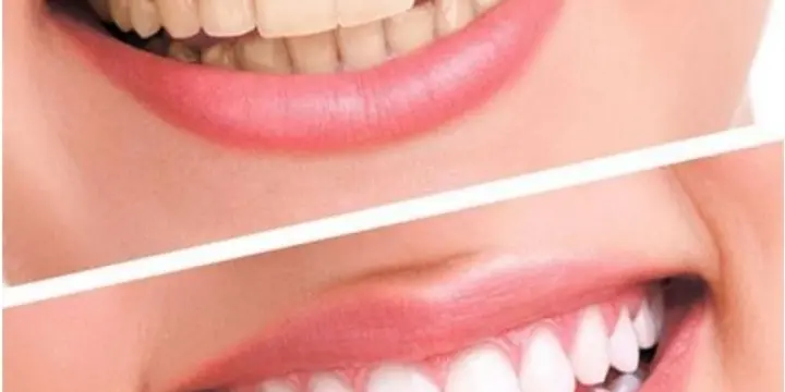 kit blanchiment dentaire